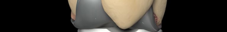 Total Knee Replacement